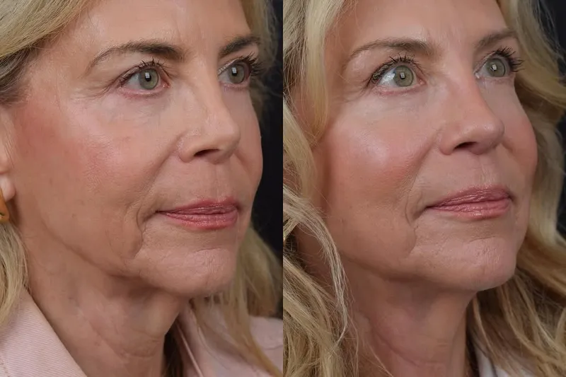 Before and after deep plane facelift, frontal view by Dr. Aaron Kosins