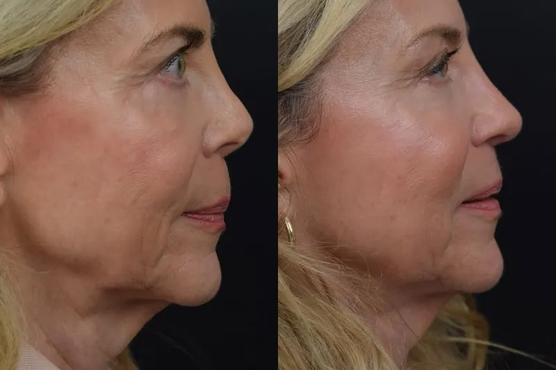 Before and after deep plane facelift, frontal view by Dr. Aaron Kosins