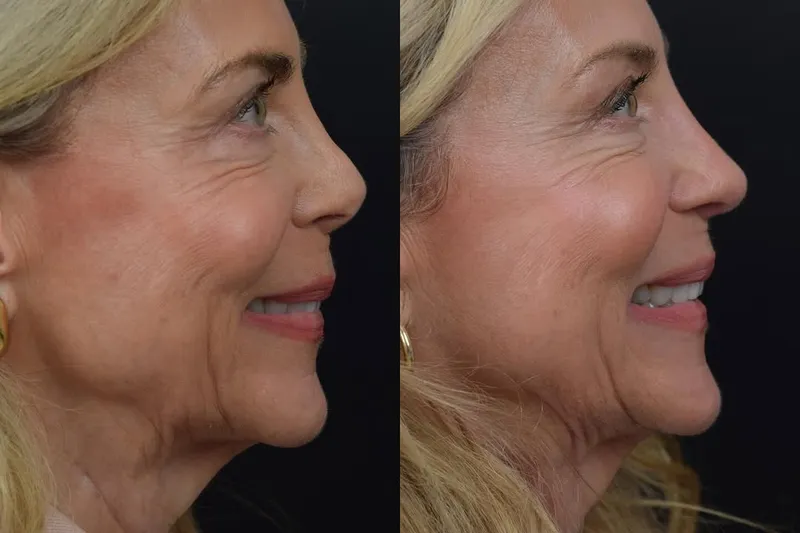 Before and after deep plane facelift, frontal view by Dr. Aaron Kosins