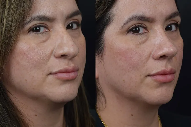 Before and after deep plane facelift, frontal view by Dr. Aaron Kosins