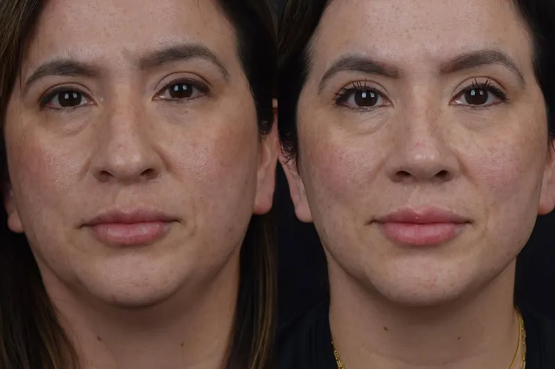 Before and after deep plane facelift, frontal view by Dr. Aaron Kosins