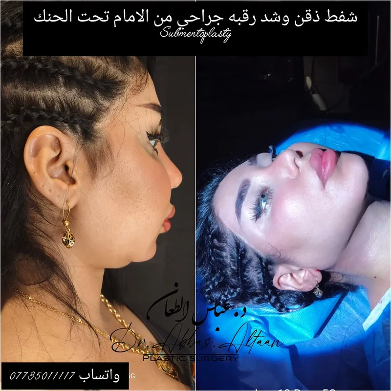 Before and after deep plane facelift — -1-year-old patient, frontal view by Dr. Abbas Altaan
