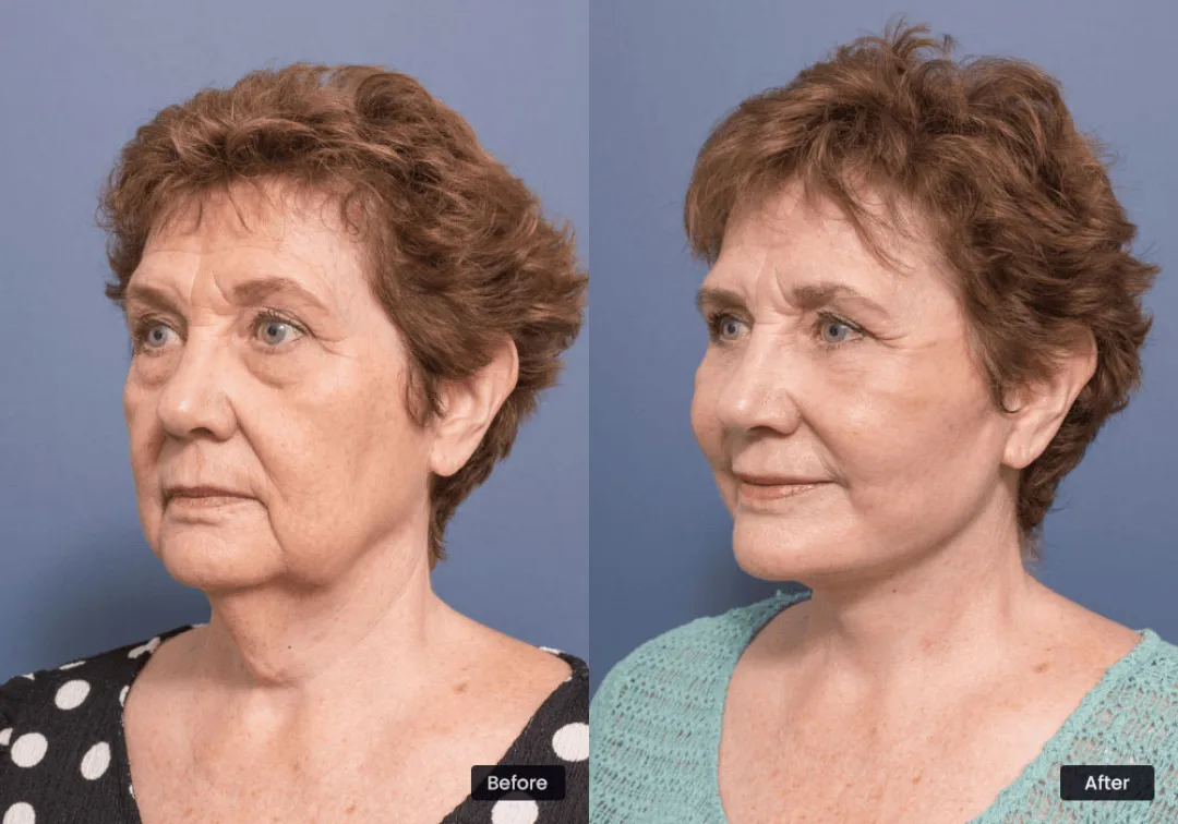 Before and after deep plane facelift — 65-year-old woman, oblique left view, 6mo post-op by Dr. Adam Honeybrook