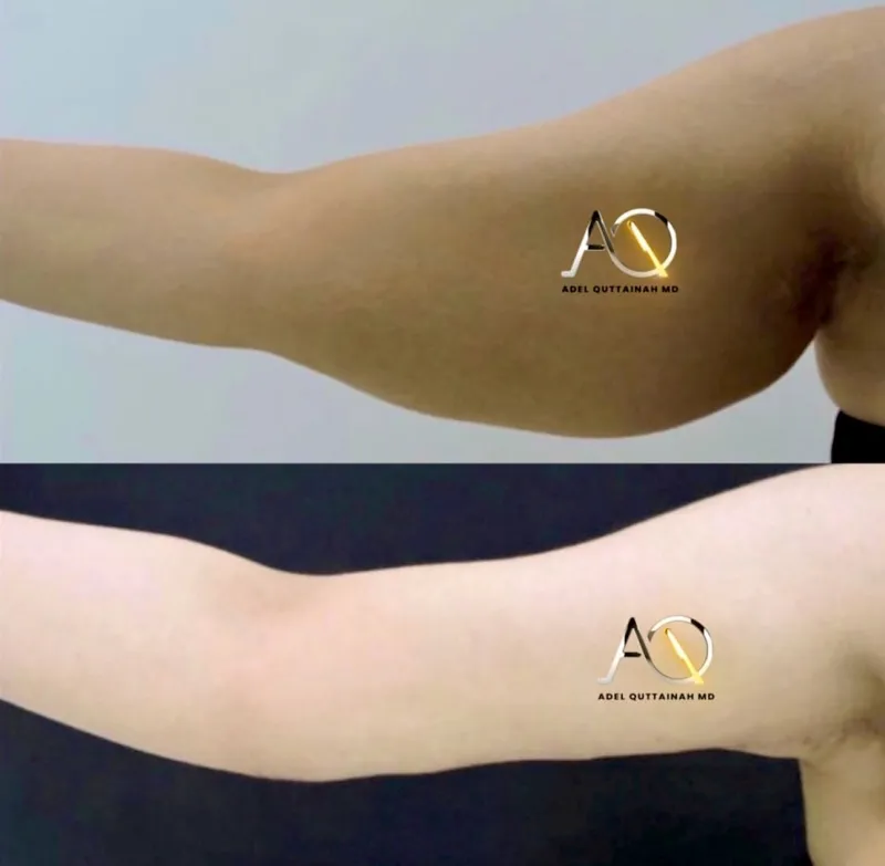 Before and after — Dr. Adel Quttainah