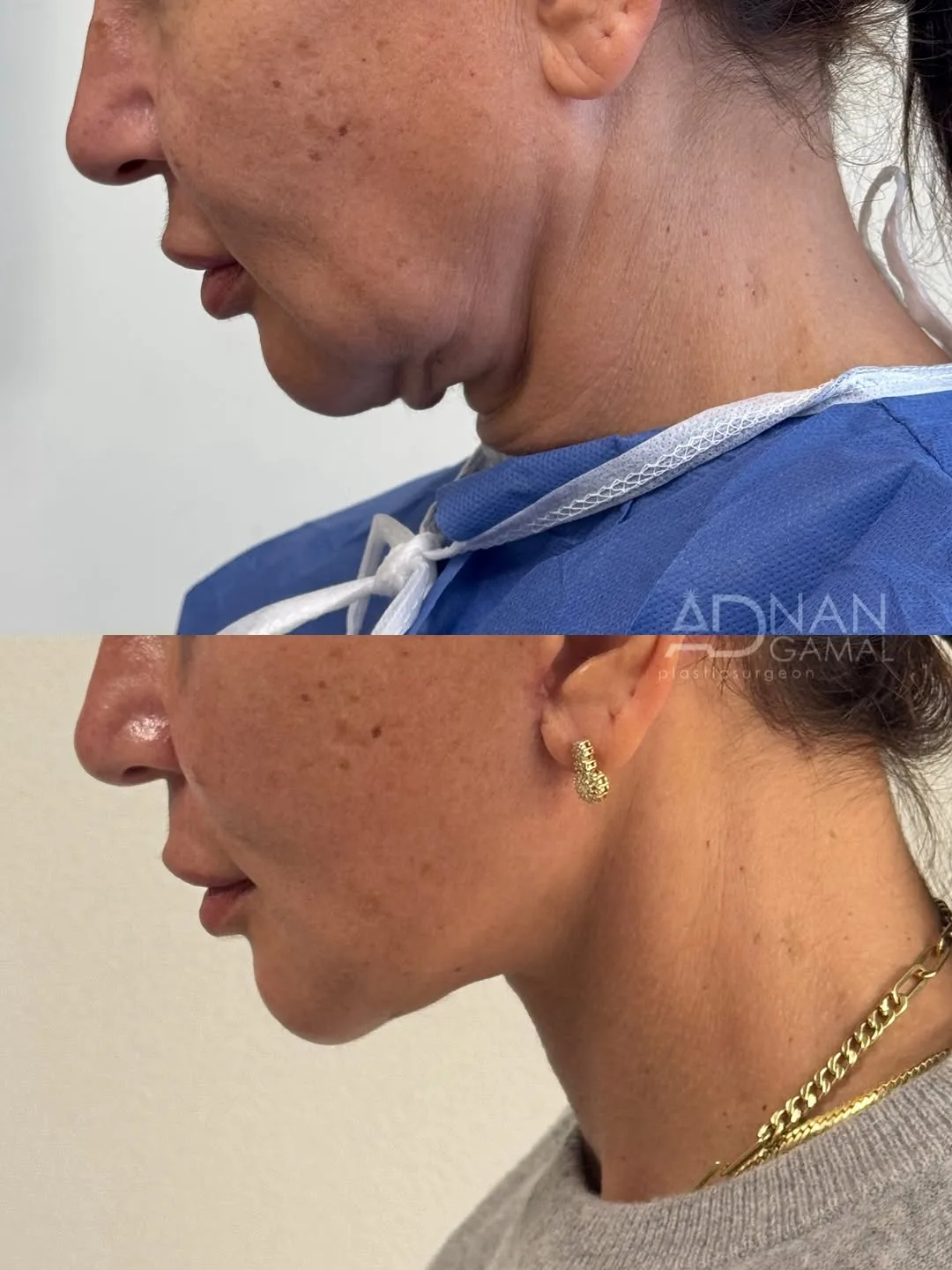 Before and after — Dr. Adnan Gamal