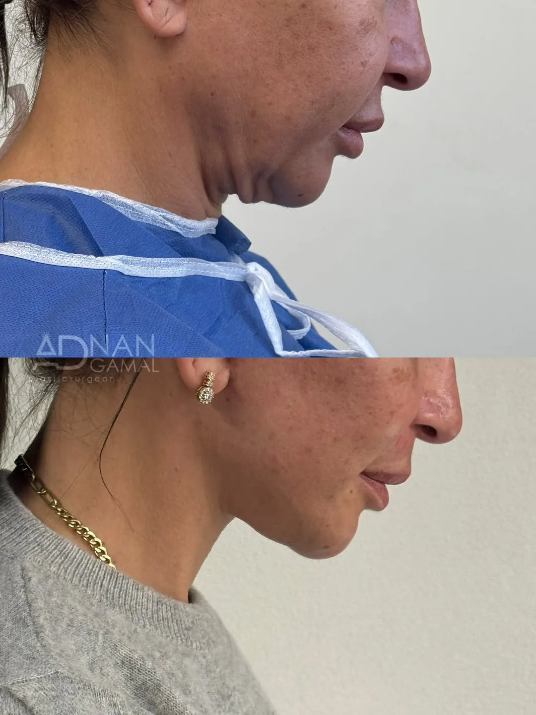 Before and after — Dr. Adnan Gamal