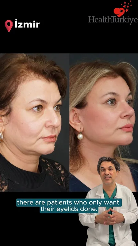 Before and after deep plane facelift — -1-year-old patient, frontal view by Dr. Ahmet Caymaz