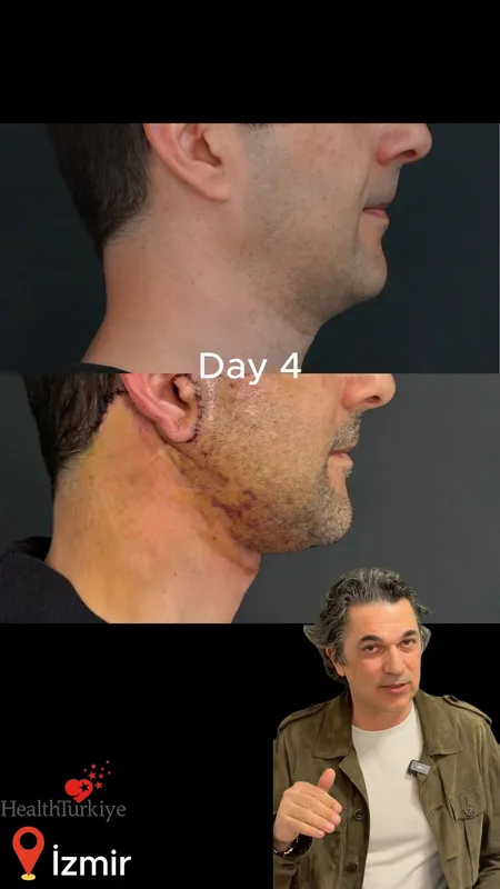 Before and after deep plane facelift — -1-year-old patient, frontal view by Dr. Ahmet Caymaz