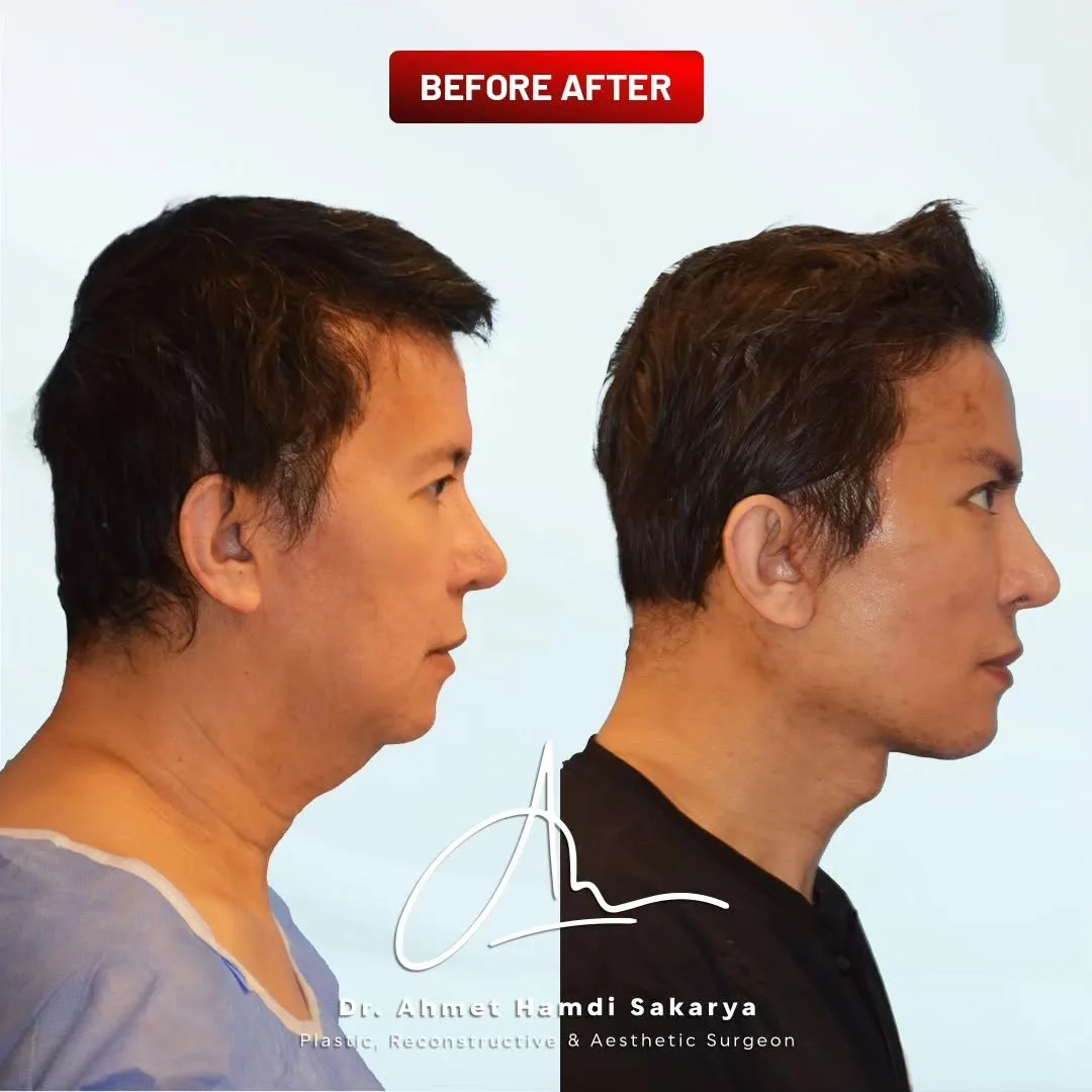 Before and after deep plane facelift — 45-year-old man, right profile view, 6mo post-op by Dr. Ahmet Hamdi Sakarya