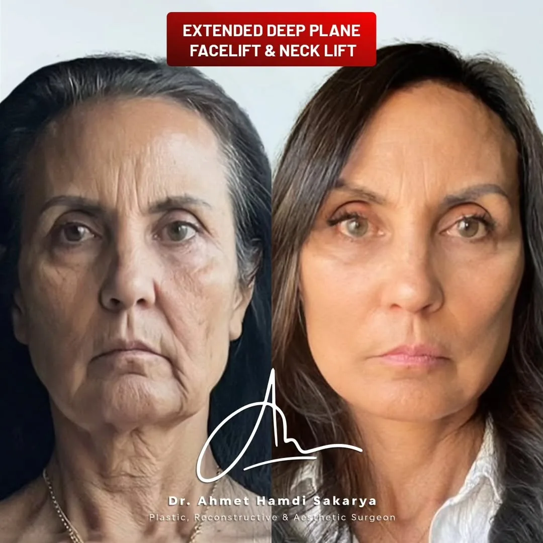 Before and after deep plane facelift — 58-year-old woman, frontal view, 2mo post-op by Dr. Ahmet Hamdi Sakarya