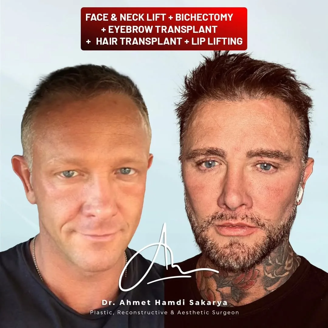 Before and after deep plane facelift — 45-year-old man, frontal view, 12mo post-op by Dr. Ahmet Hamdi Sakarya