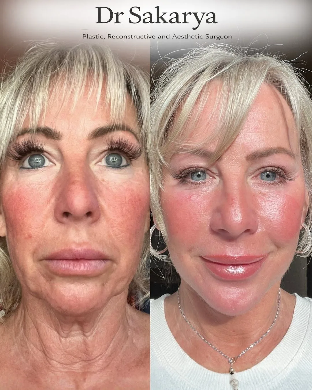 Before and after deep plane facelift — 58-year-old woman, frontal view, 3mo post-op by Dr. Ahmet Hamdi Sakarya