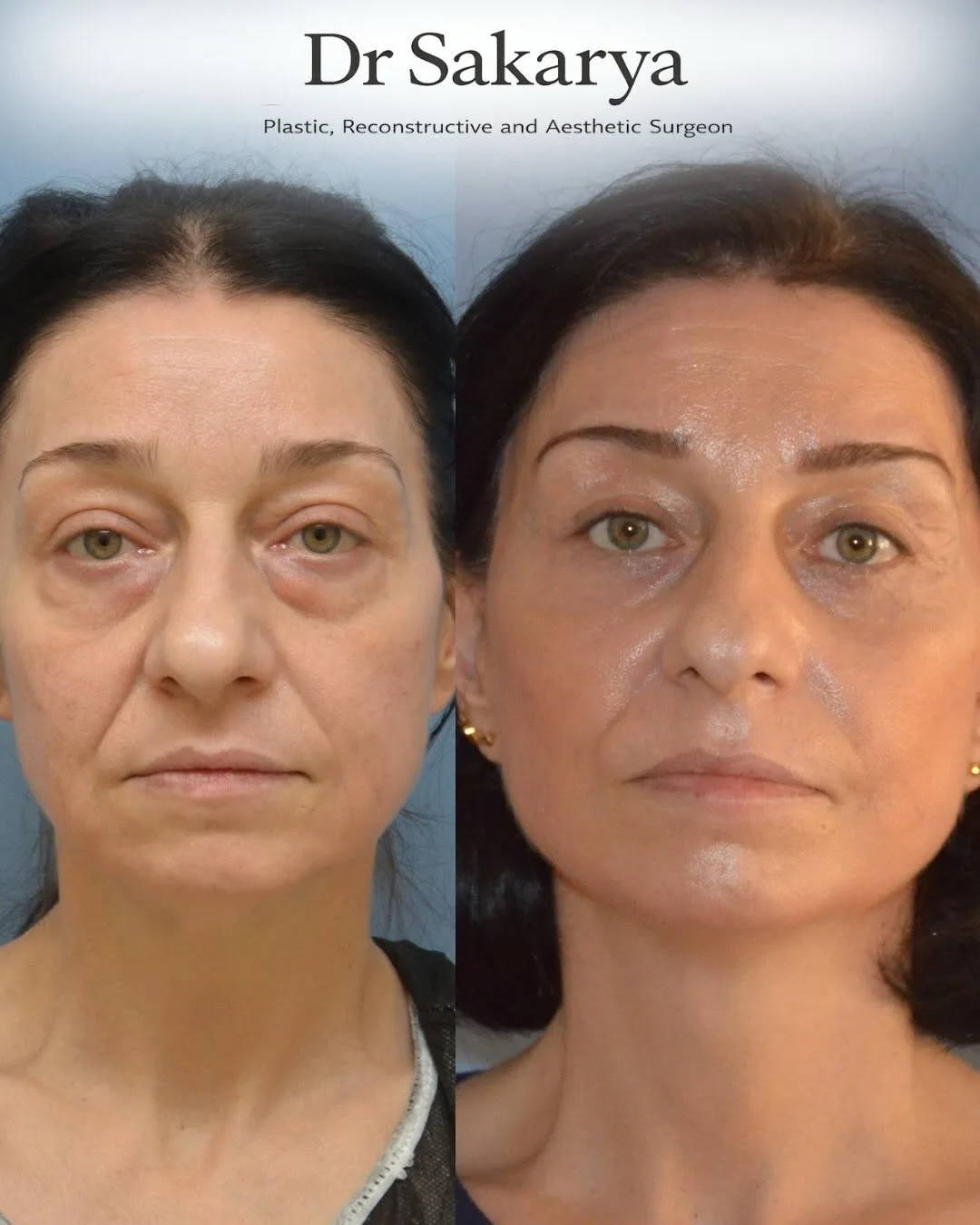 Before and after deep plane facelift — 52-year-old woman, frontal view, 6mo post-op by Dr. Ahmet Hamdi Sakarya