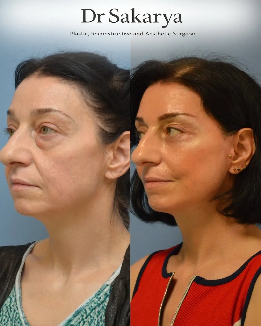 Before and after deep plane facelift — 52-year-old woman, left profile view, 6mo post-op by Dr. Ahmet Hamdi Sakarya