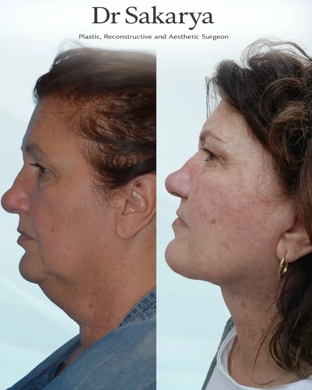 Before and after deep plane facelift — 45-year-old woman, left profile view, 3mo post-op by Dr. Ahmet Hamdi Sakarya