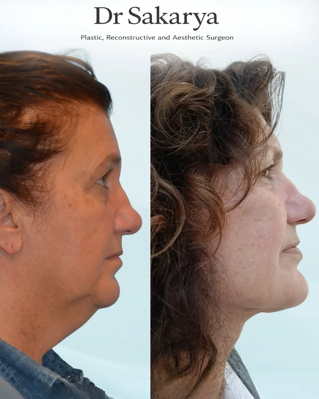 Before and after deep plane facelift — 45-year-old woman, right profile view, 3mo post-op by Dr. Ahmet Hamdi Sakarya