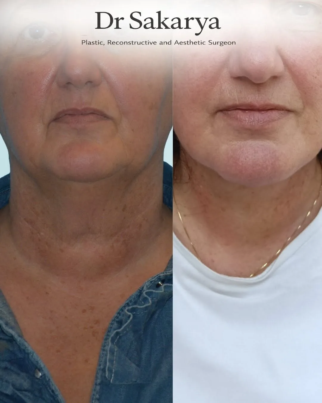 Before and after deep plane facelift — 55-year-old woman, oblique left view, 3mo post-op by Dr. Ahmet Hamdi Sakarya