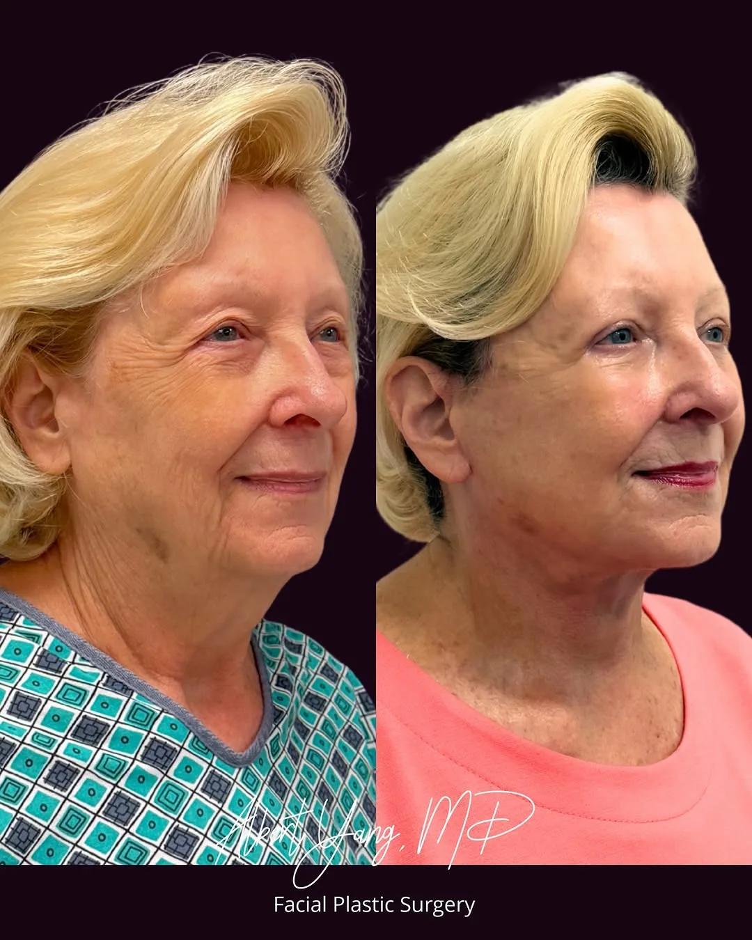 Before and after — Dr. Albert Yang