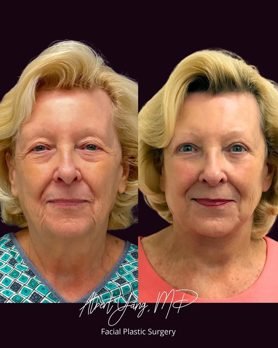 Before and after — Dr. Albert Yang
