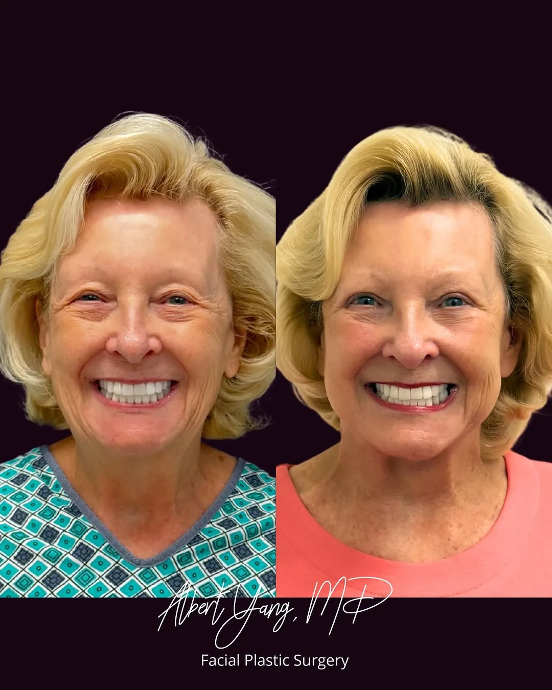 Before and after — Dr. Albert Yang