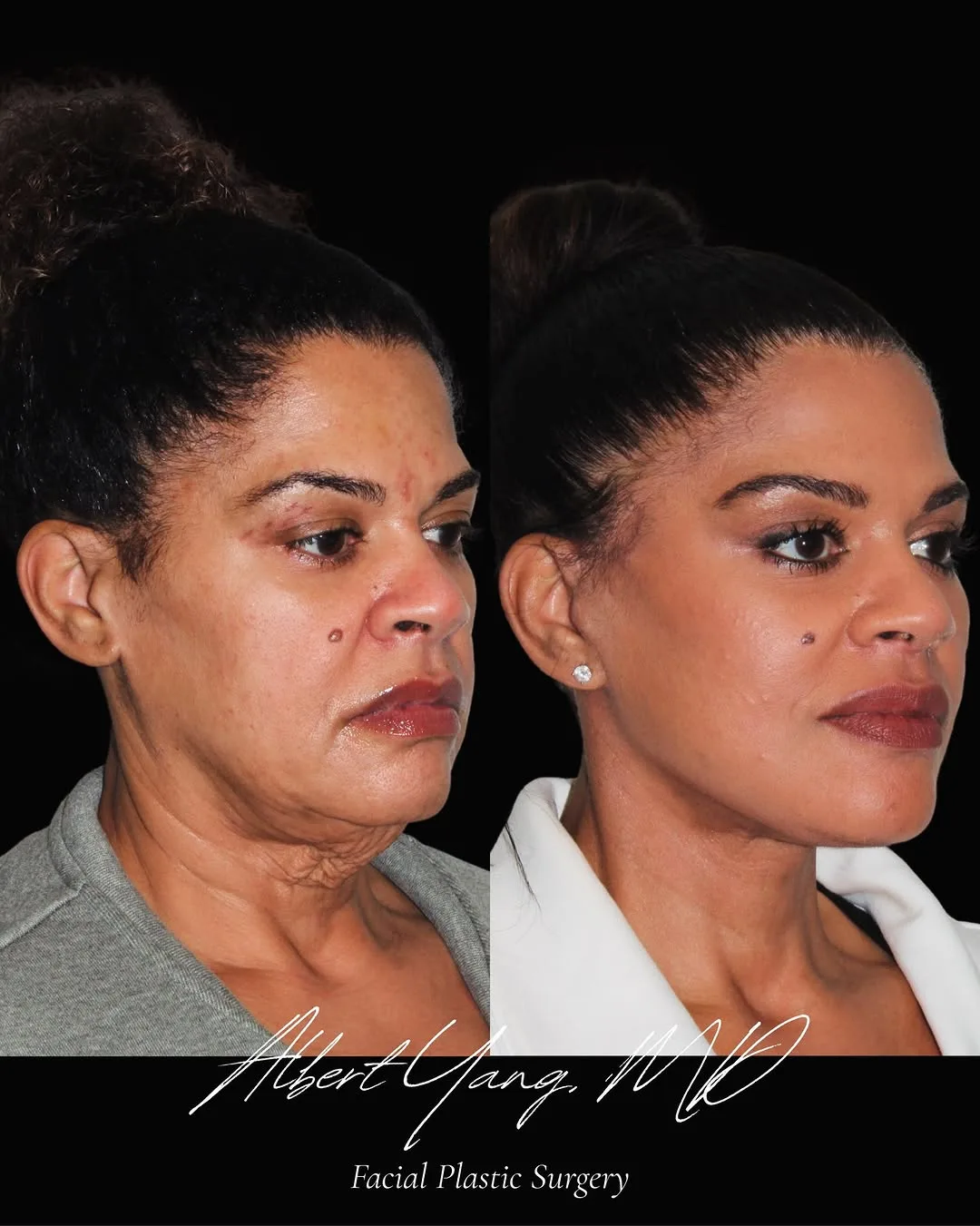 Before and after — Dr. Albert Yang