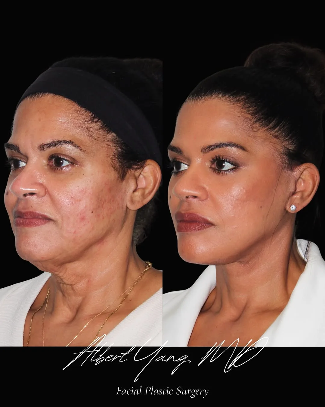 Before and after — Dr. Albert Yang