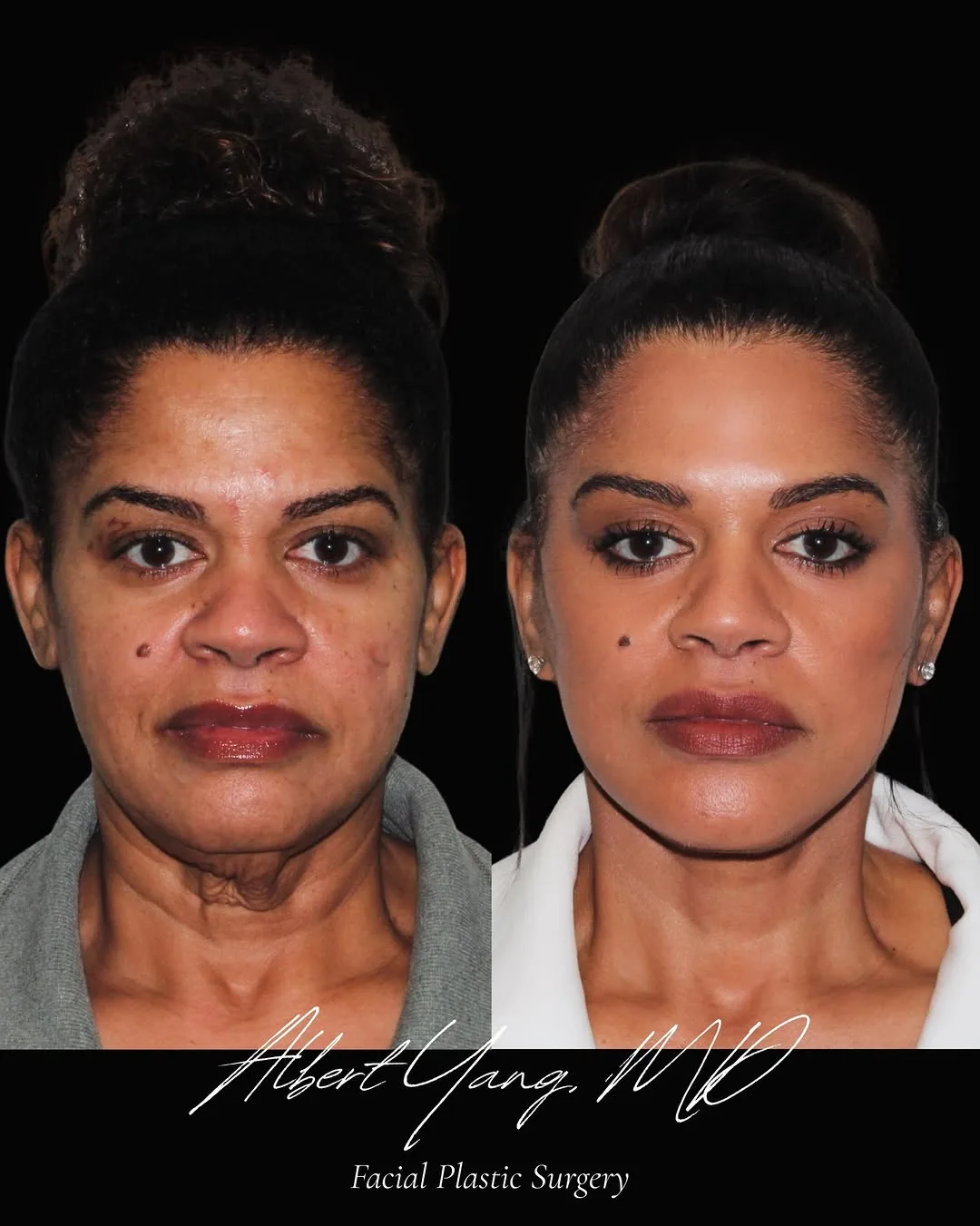 Before and after — Dr. Albert Yang