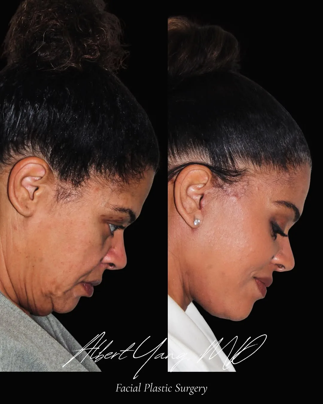 Before and after — Dr. Albert Yang
