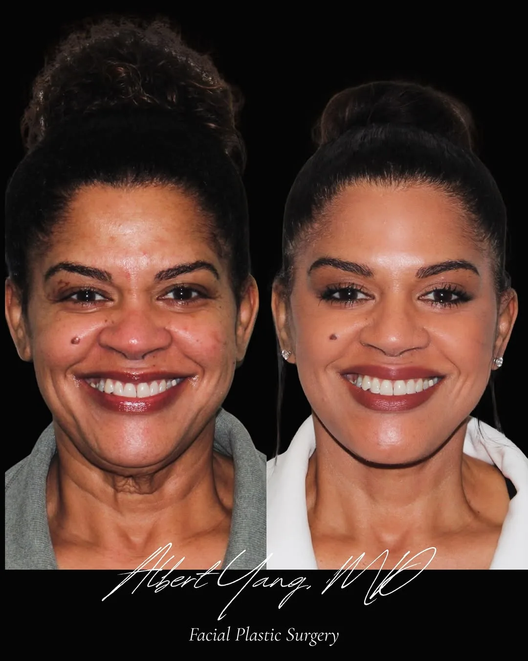 Before and after — Dr. Albert Yang