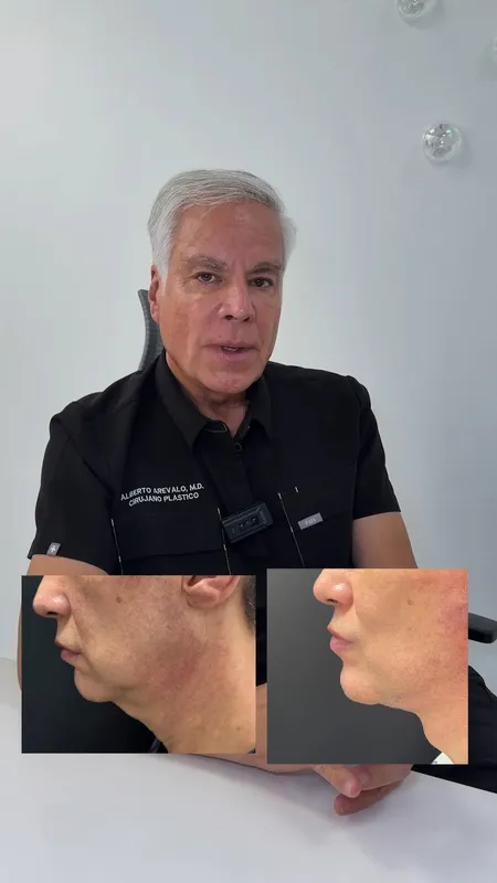 Before and after deep plane facelift — -1-year-old patient, frontal view by Dr. Alberto Arevalo