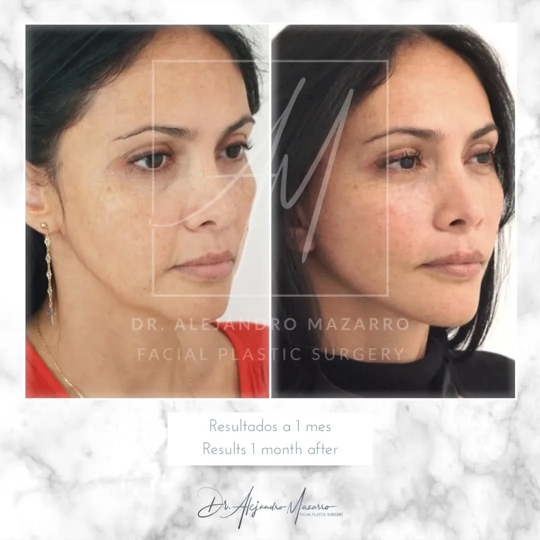 Before and after — Dr. Alejandro Mazarro