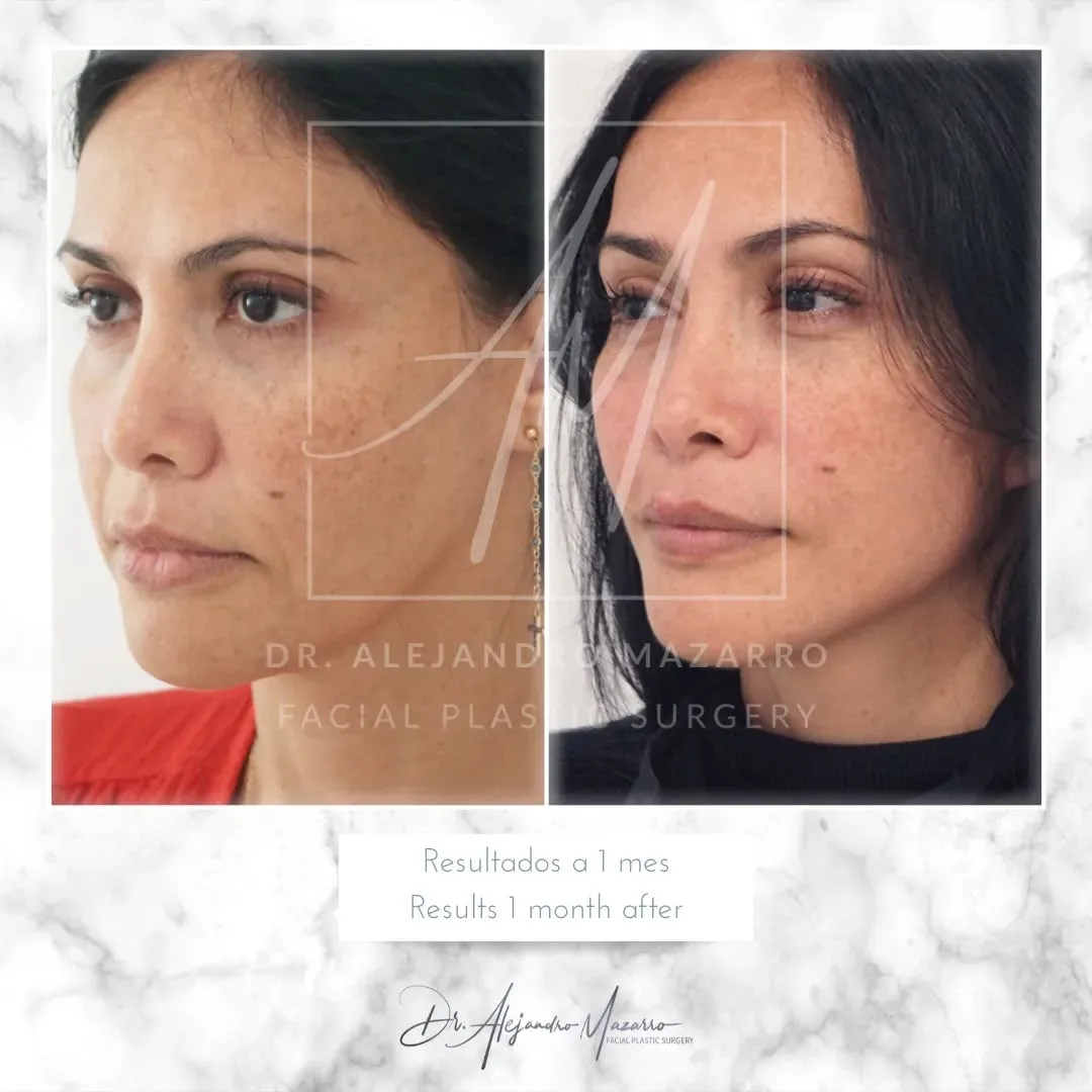 Before and after — Dr. Alejandro Mazarro