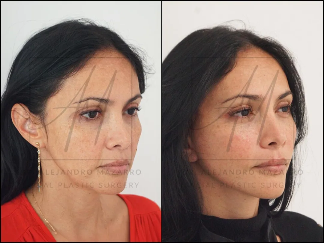 Before and after — Dr. Alejandro Mazarro