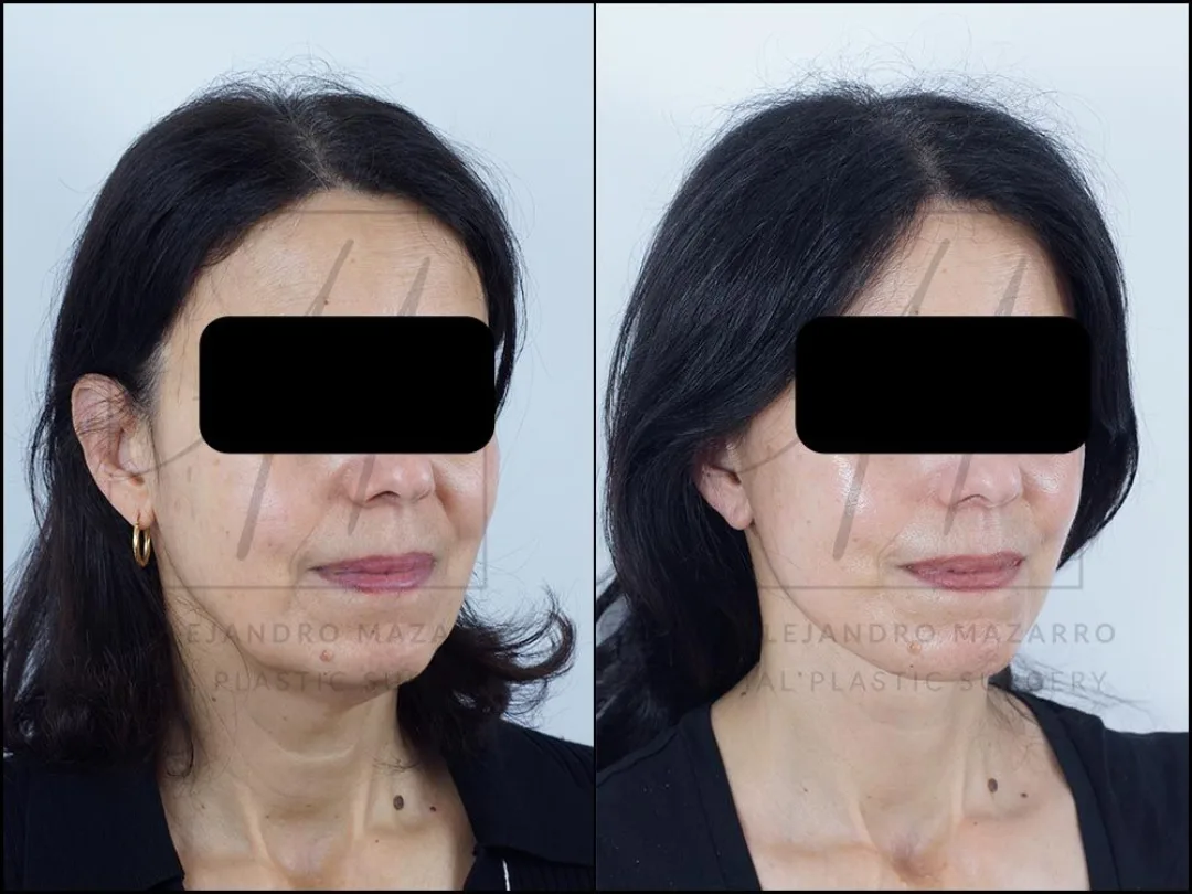 Before and after — Dr. Alejandro Mazarro