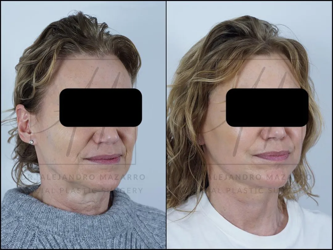 Before and after — Dr. Alejandro Mazarro