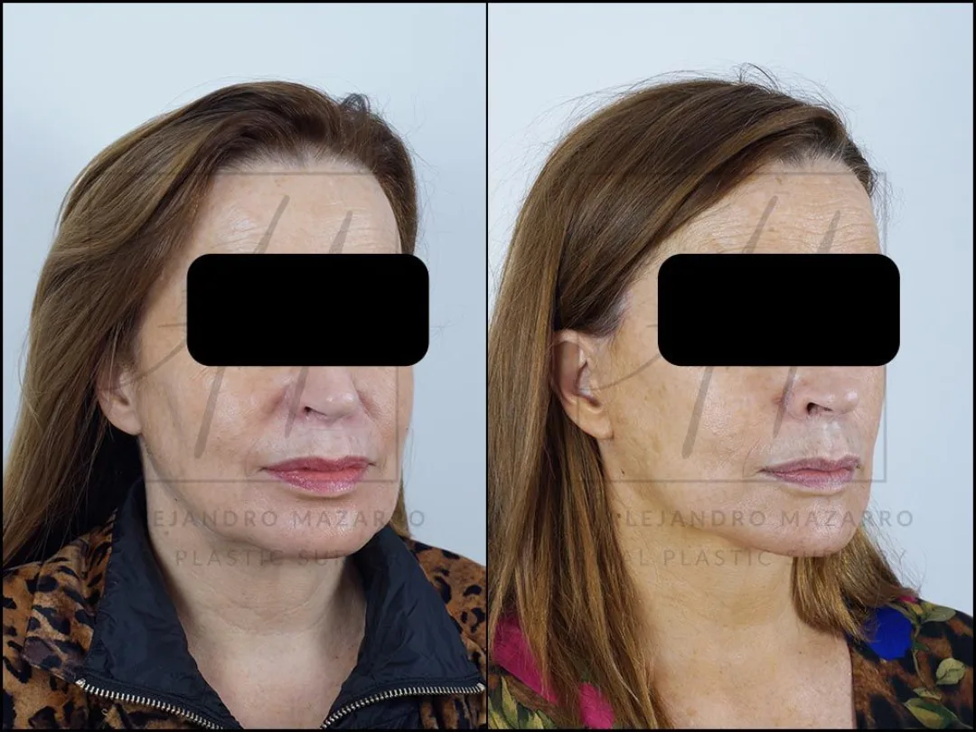 Before and after — Dr. Alejandro Mazarro