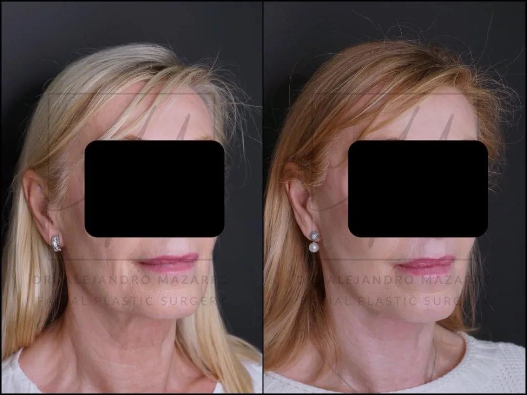 Before and after: Dr. Alejandro Mazarro