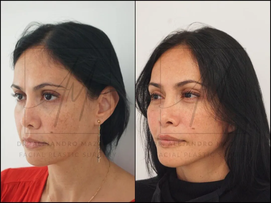 Before and after — Dr. Alejandro Mazarro