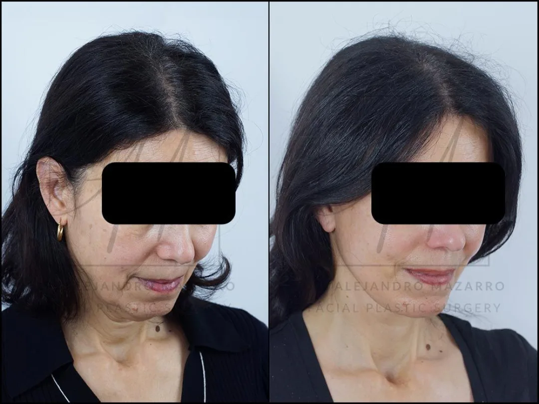 Before and after — Dr. Alejandro Mazarro