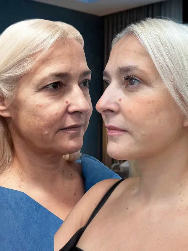 Before and after — Dr. Alessandro Gualdi