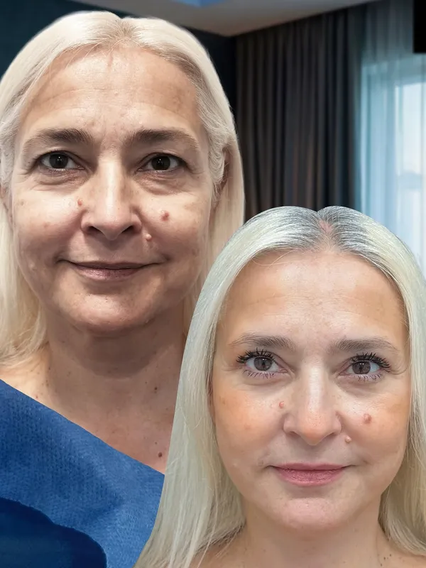 Before and after — Dr. Alessandro Gualdi