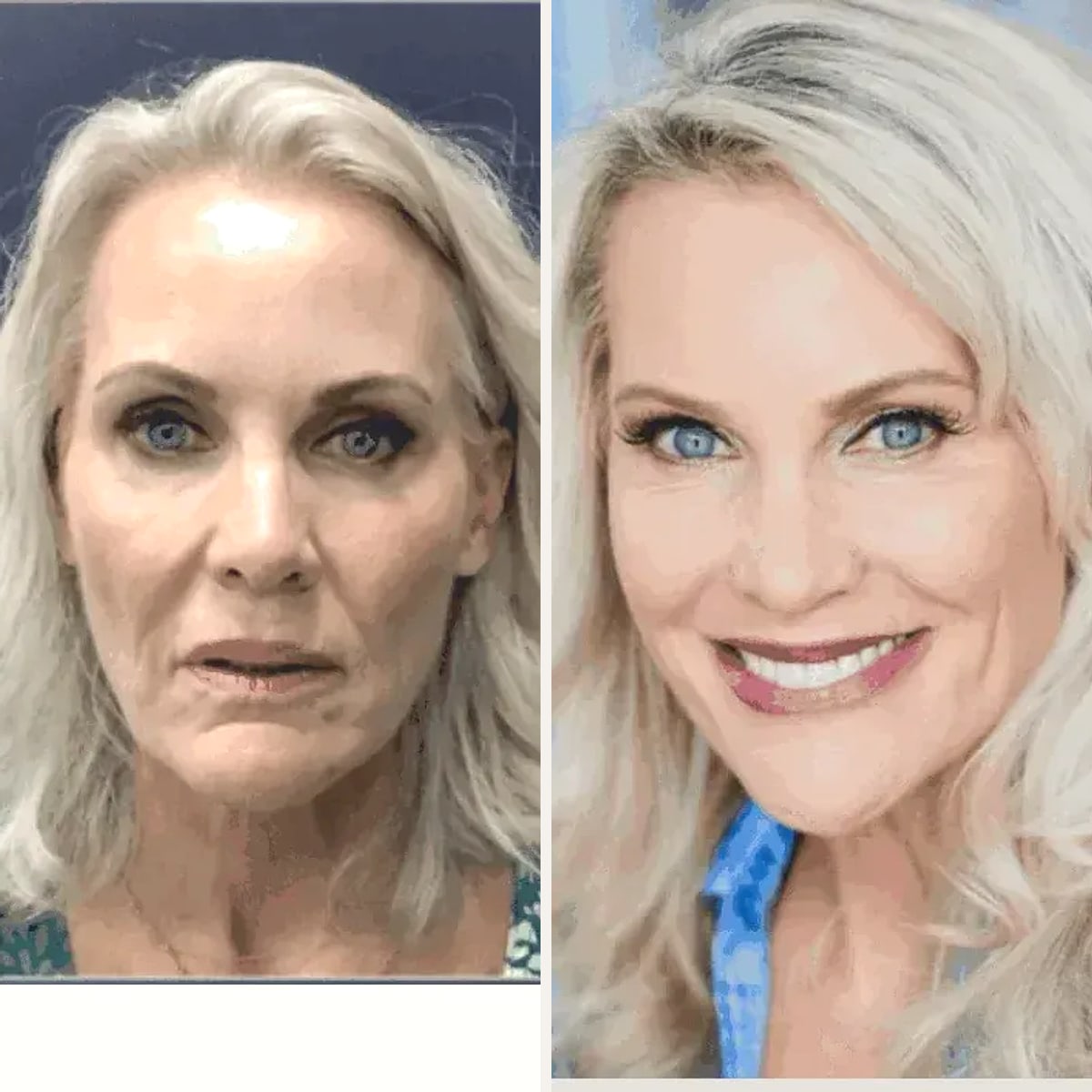 Before & After - Deep Plane Facelift by Dr. Alex Campbell