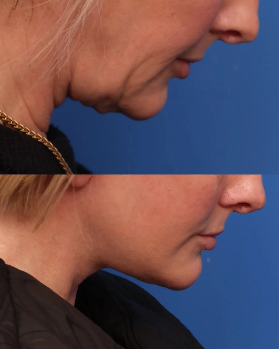 Before and after — Dr. Alex Caniglia