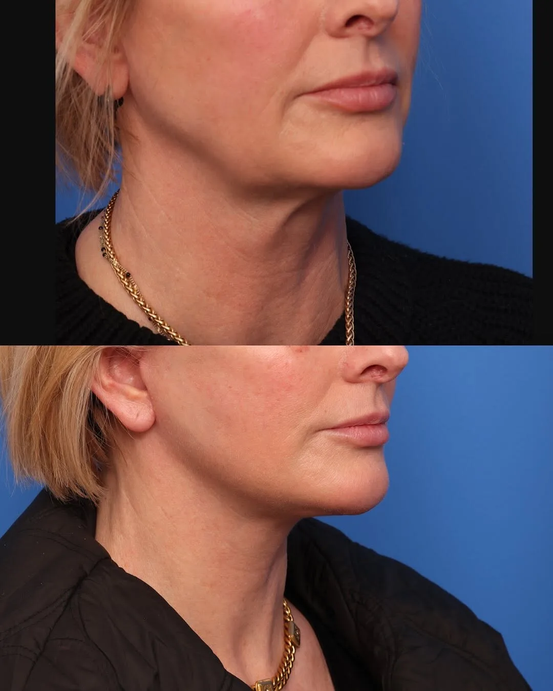 Before and after — Dr. Alex Caniglia