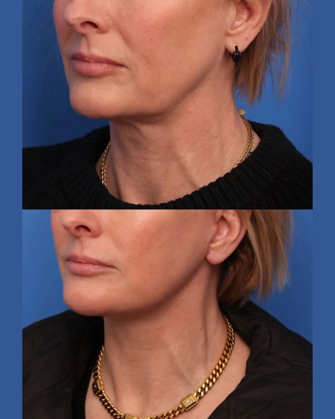 Before and after — Dr. Alex Caniglia