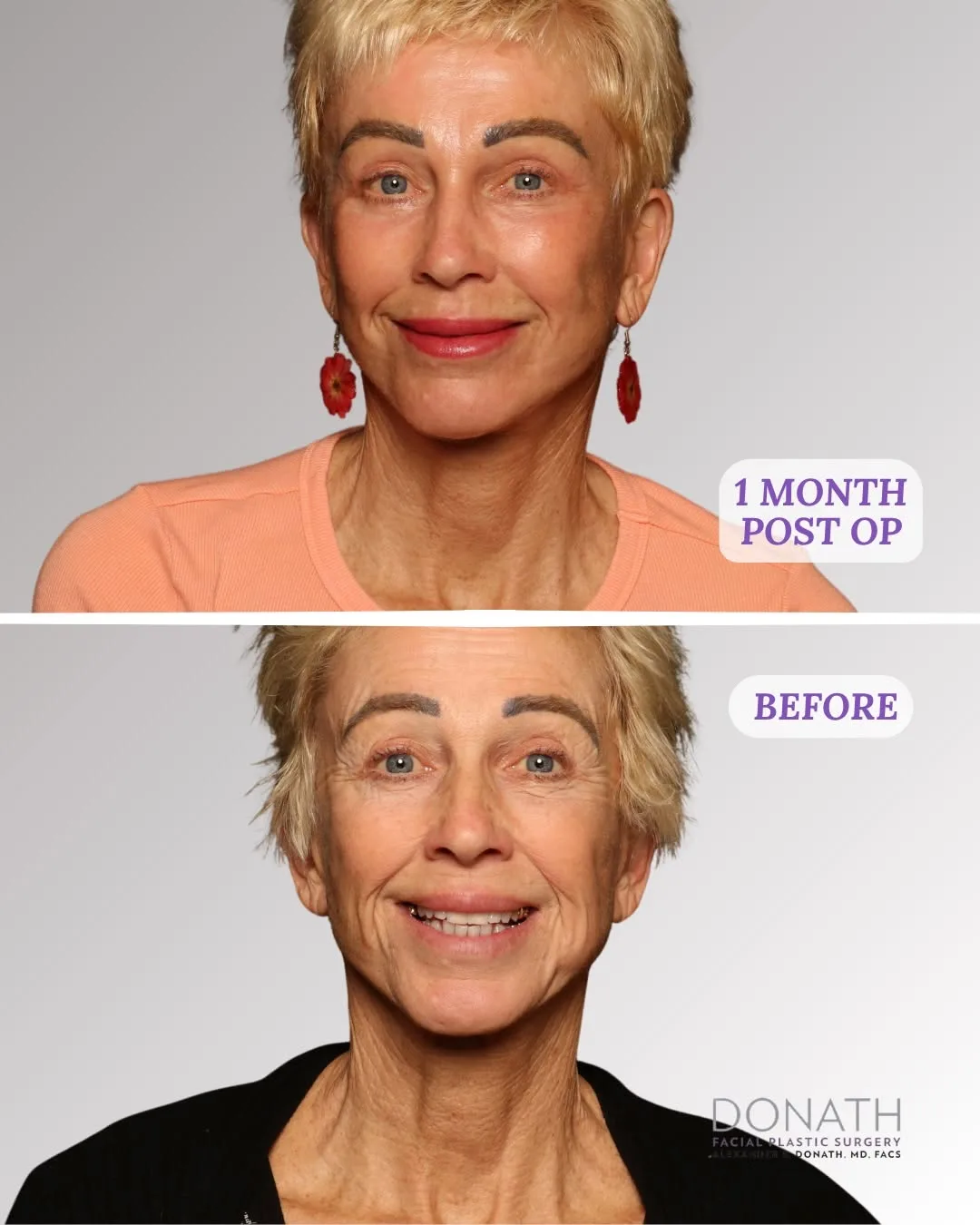 Before and after — Dr. Alexander Donath