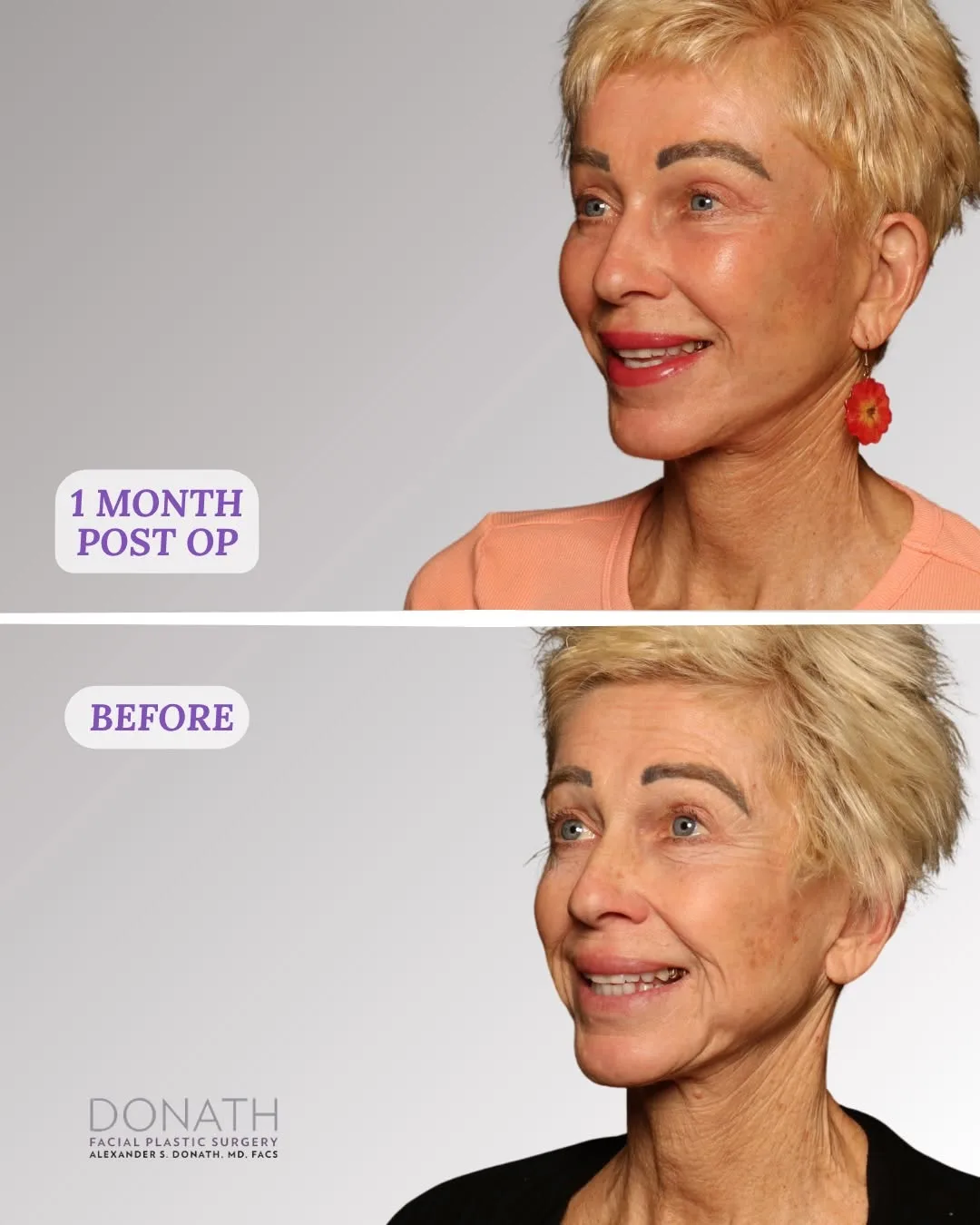 Before and after — Dr. Alexander Donath