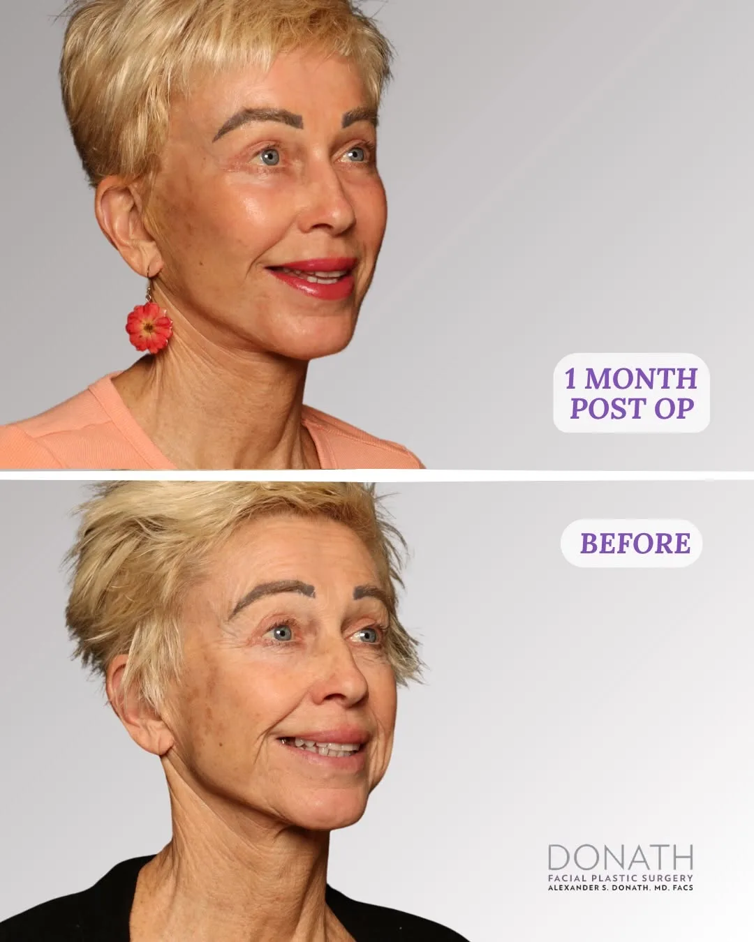 Before and after — Dr. Alexander Donath
