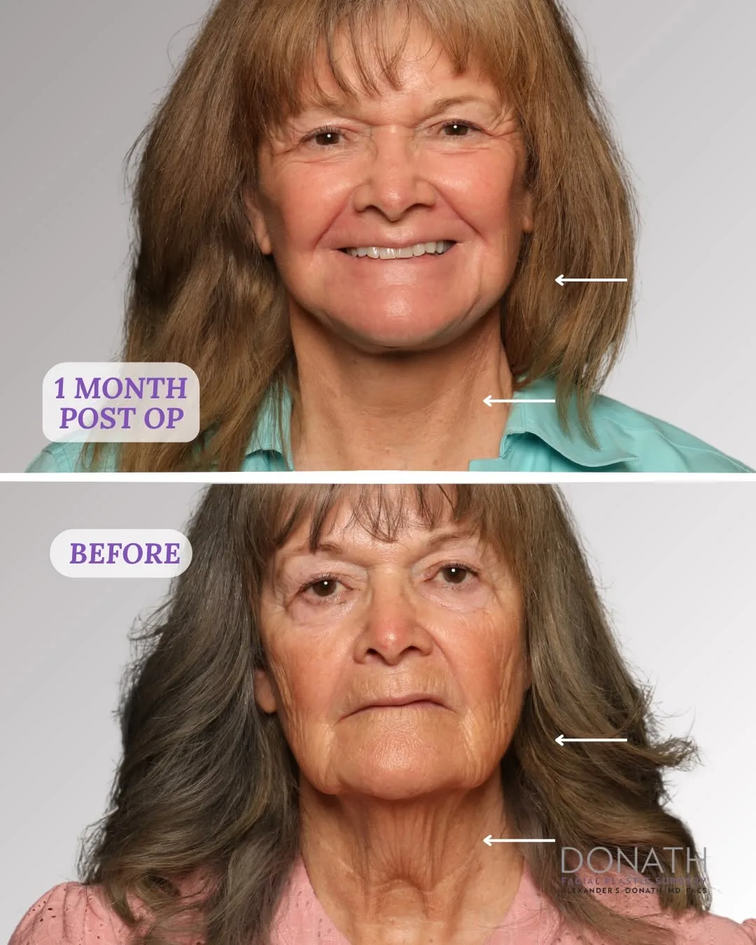 Before and after — Dr. Alexander Donath