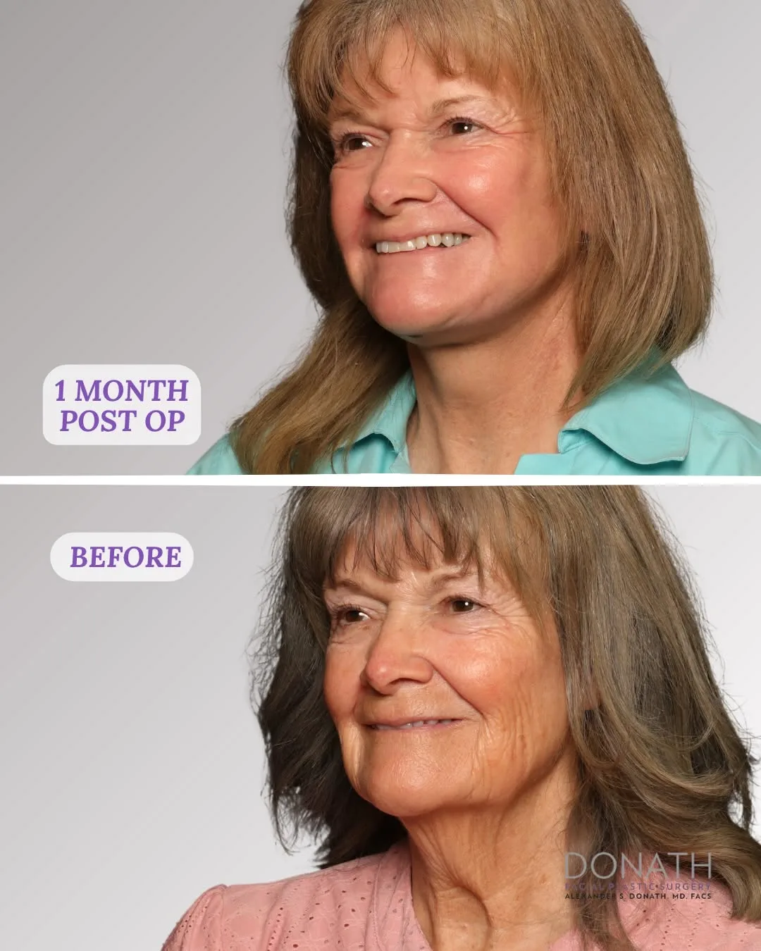 Before and after — Dr. Alexander Donath